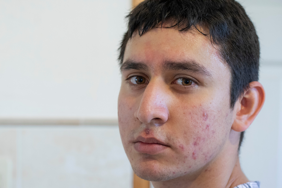 Ingrown Hair Boil and Skin Boil 101 Urth Skin Solutions