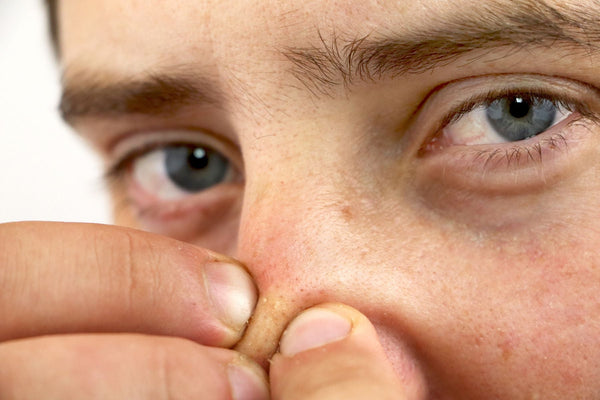 man with large pores and blackheads squeezing nose with fingers, urth