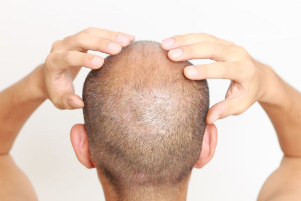 men's hair loss 