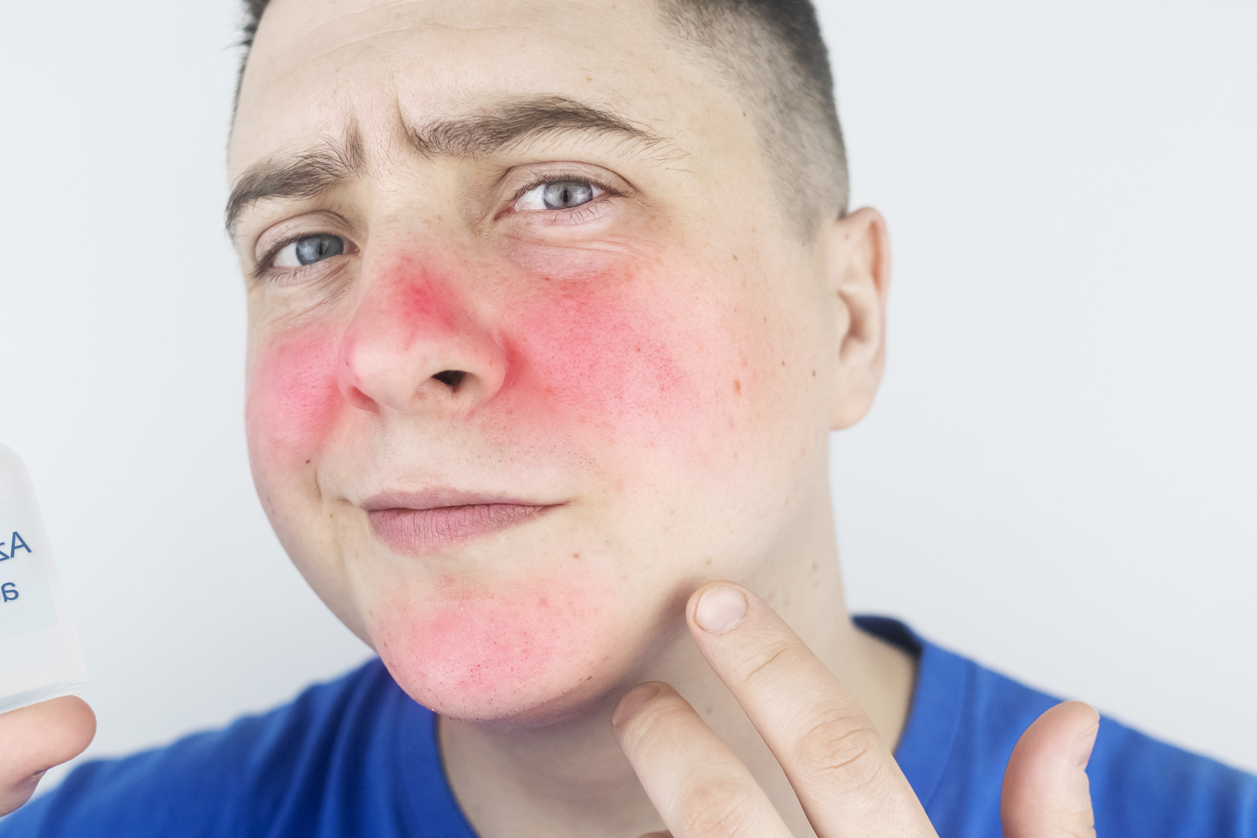 Fine Red Facial Rash CAUSES FOR FACIAL REDNESS – Urth Skin Solutions