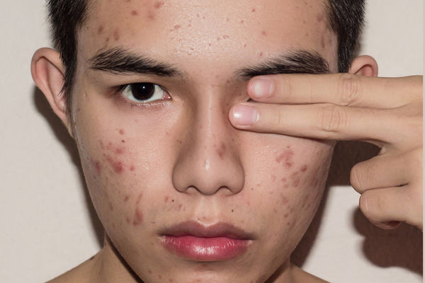 young man with acne on face, has index and middle finger covering one eye.  The background is  light tan.