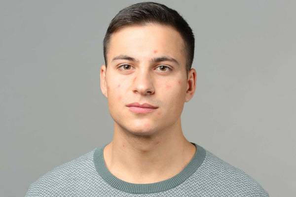 young men's with acne on face
